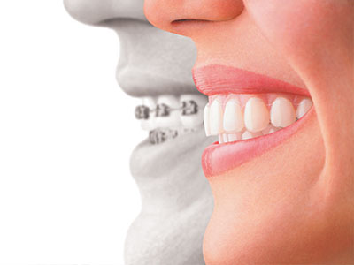 Albee Dental Care | Dental Sealants, Implant Dentistry and Dentures