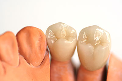 Albee Dental Care | Dental Cleanings, Veneers and Dentures