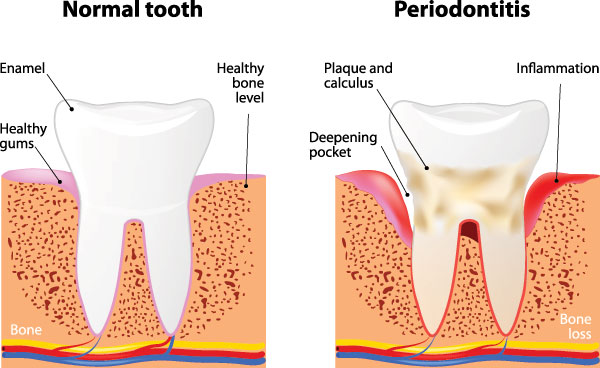Albee Dental Care | Periodontal Treatment, Emergency Treatment and Night Guards