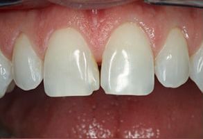 Albee Dental Care | Veneers, Preventative Program and TMJ Disorders